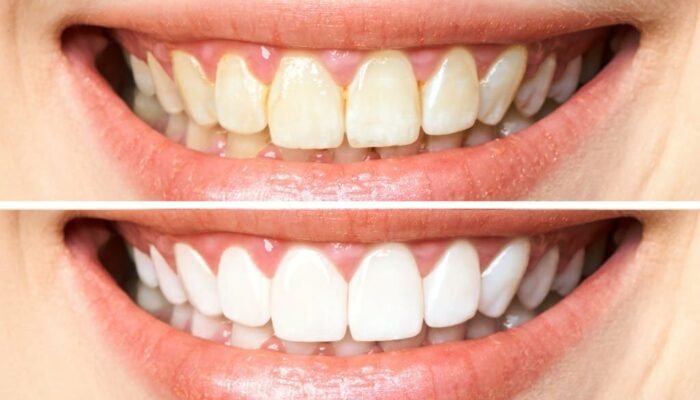 GetPaidStock.com-6538d8bb5c699 woman teeth before and after whitening. Over white background. Dental clinic patient. Image symbolizes oral care dentistry, stomatology.