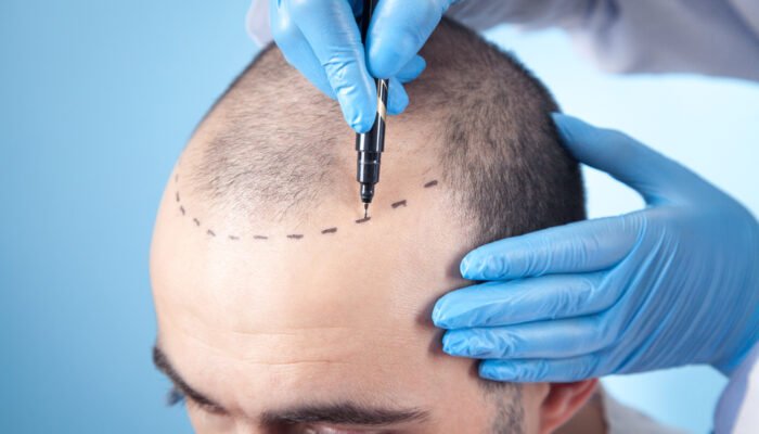 Patient,Suffering,From,Hair,Loss,In,Consultation,With,A,Doctor.