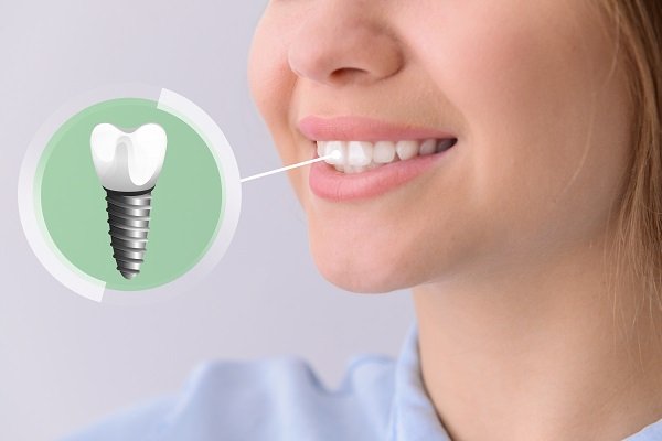 Young,Woman,With,Implanted,Teeth,On,Light,Background,,Closeup Young,Woman,With,Implanted,Teeth,On,Light,Background,,Closeup