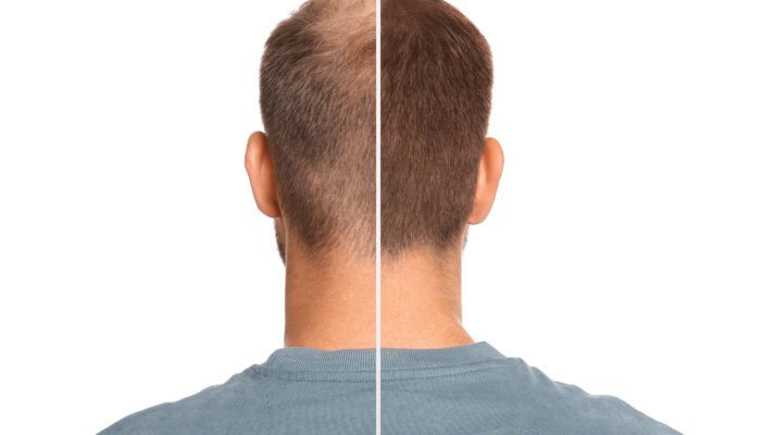hair-transplant-all-you-need-to-know