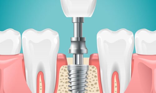 Dental surgery. Tooth implant cut vector illustration. Healthy teeth and dental implant, stomatology poster Dental surgery. Tooth implant cut vector illustration. Healthy teeth and dental implant, stomatology poster. Implant dental metal screw in gum