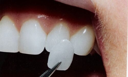 dental-lumineers-livonia-new dental-lumineers-livonia-new