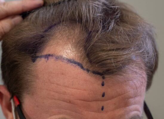 dhi-hair-transplant-male-pattern-baldness