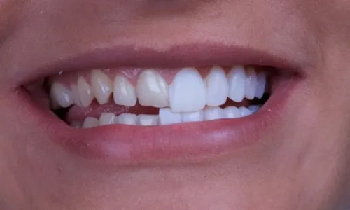porcelain-veneers-putney-1.jpg porcelain-veneers-putney-1.jpg