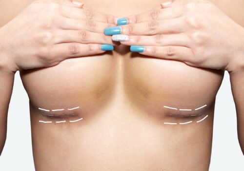 Scar,After,Breast,Surgery,On,White,Background