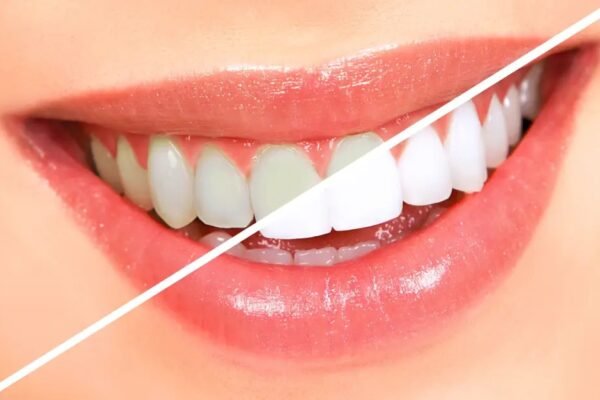 teeth-whitening-1