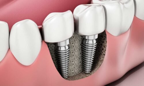 titanium-dental-implant-orlando-fl titanium-dental-implant-orlando-fl